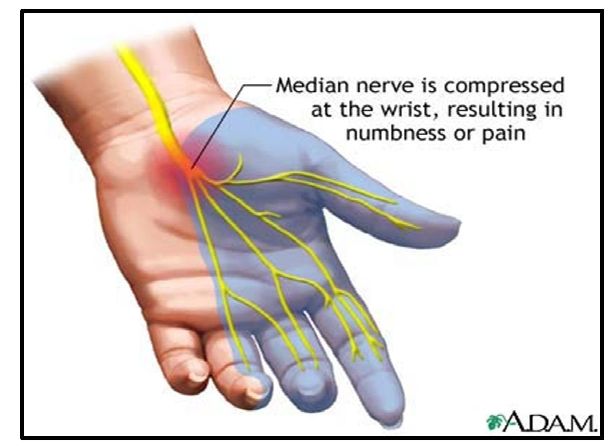 Can Carpal Tunnel Cause Severe Pain